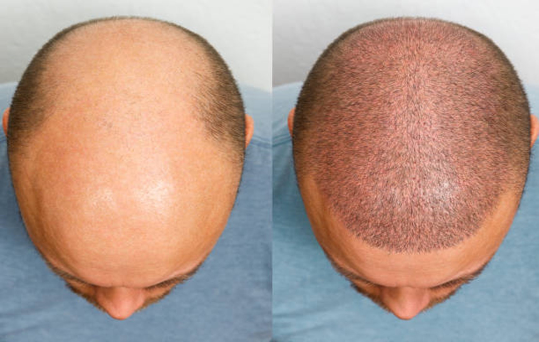 زراعة الشعر