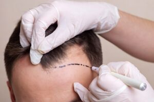 Front Hairline Design For Hair Transplant