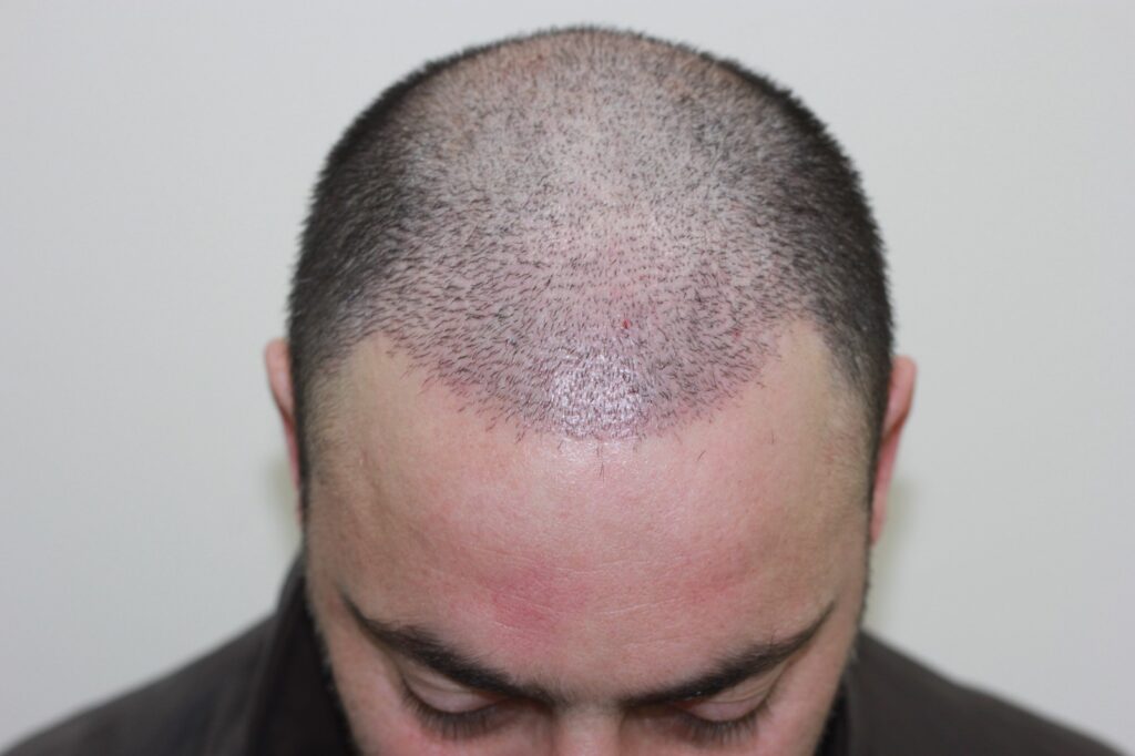 Hair Transplant