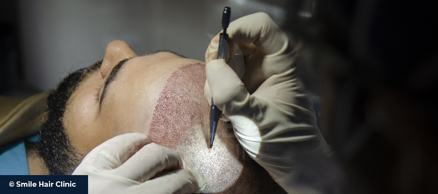 hair follicle surgery