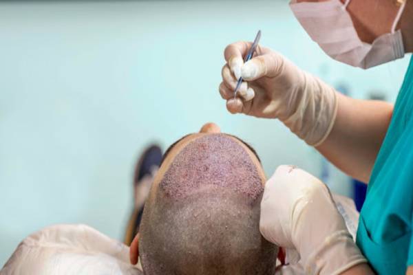 hair implant surgery