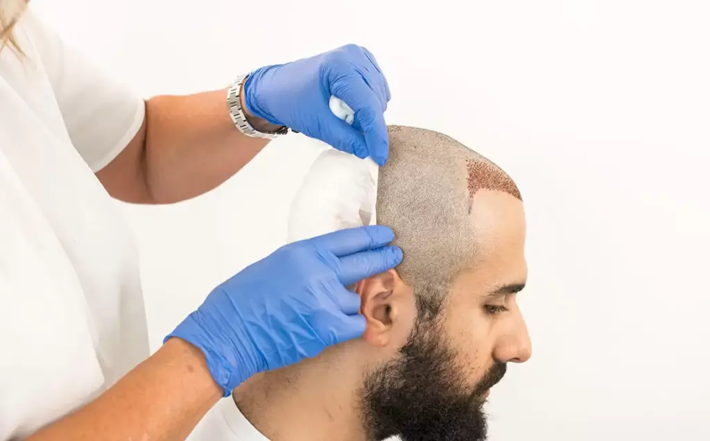 chirurgie des follicules pileux