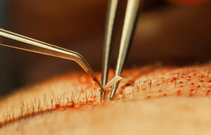 hair follicle surgery