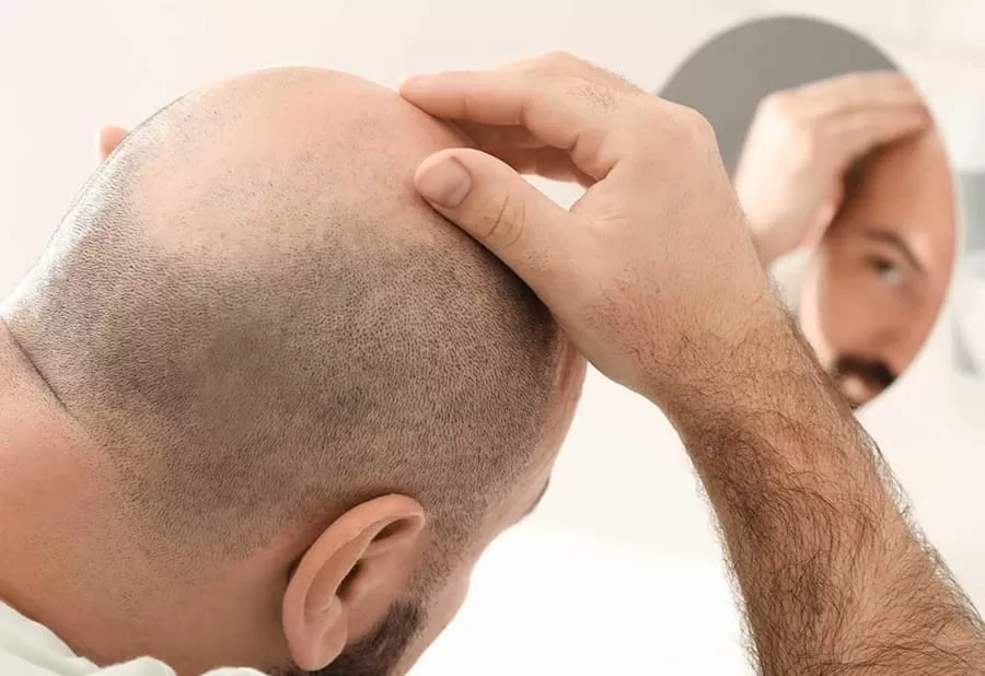 hair graft cost