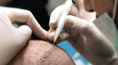hair transplant process