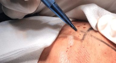 hair transplant process sapphire
