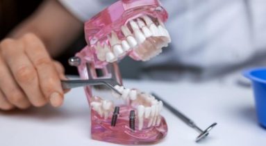 4 Types of Dental Implant