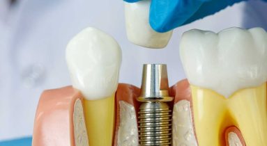 Dental implant Turkeymed